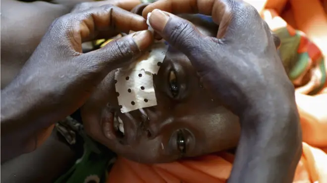 Un enfant atteint de leishmaniose