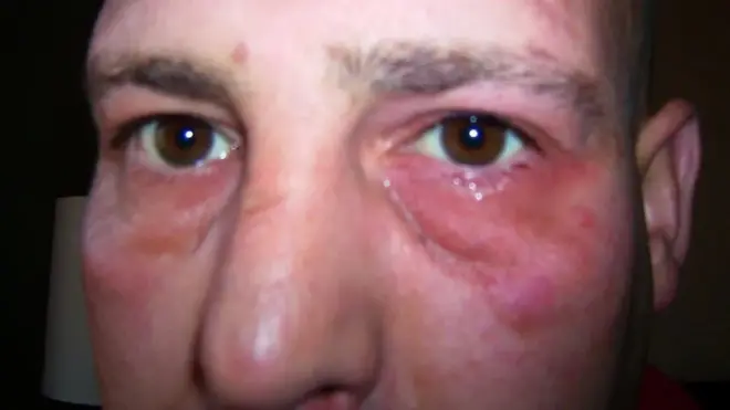 UK health ,headache, rare medical condition cluster headache