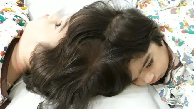 Safa y Marwa son gemelas craniopagus, es decir, nacieron unidas por el cráneo.