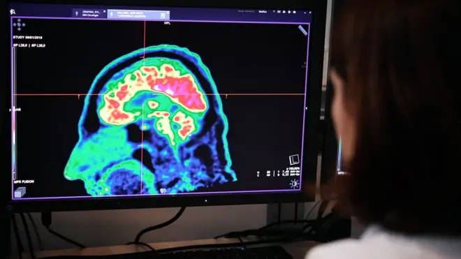 صورة أشعة للدماغ
