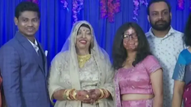 Acid Attack Survivor