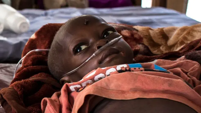 malnourished child in Tshikapa