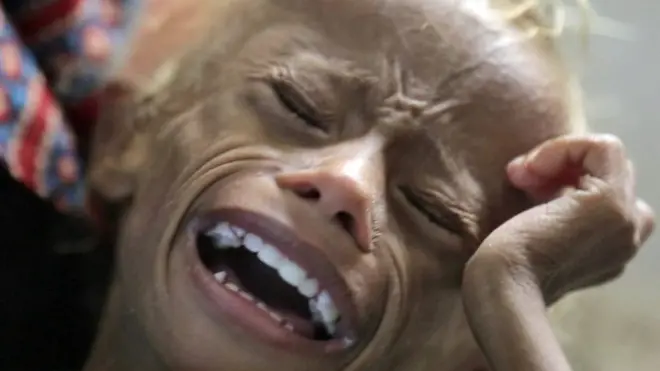 El niño Saleem en Yemen