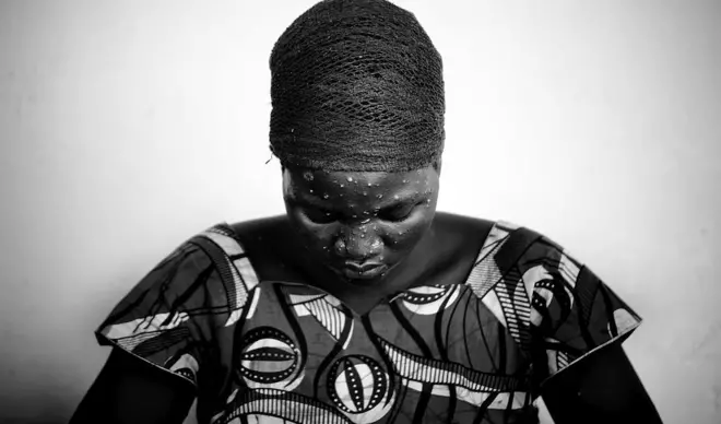 Eeyan to ni aarun Monkeypox