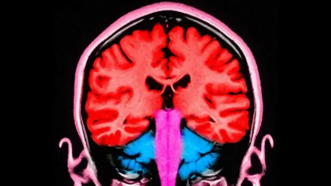 Компьютерный снимок мозга
