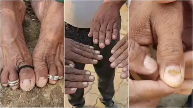 پہلے ناخن سخت ہوتے ہیں پھر ان پر پیلے دھبے پڑتے ہیں پھر ٹوٹنے لگتے ہیں