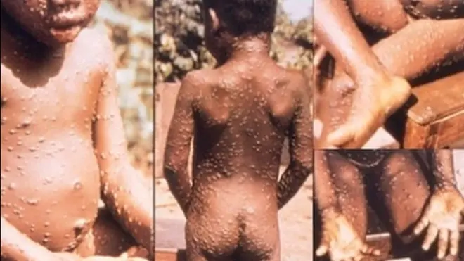 Monkeypox infection no get cure and since dis new cases dem happen e never kill anybody