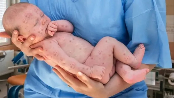 kızamık olmuş bir bebek