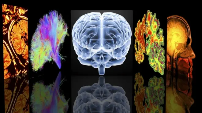 بیماری ام اس