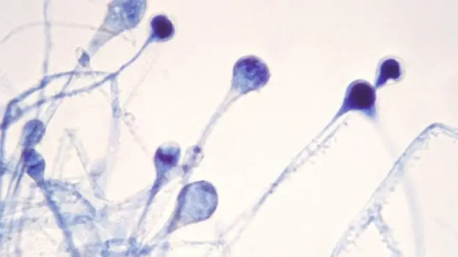 బ్లాక్ ఫంగస్