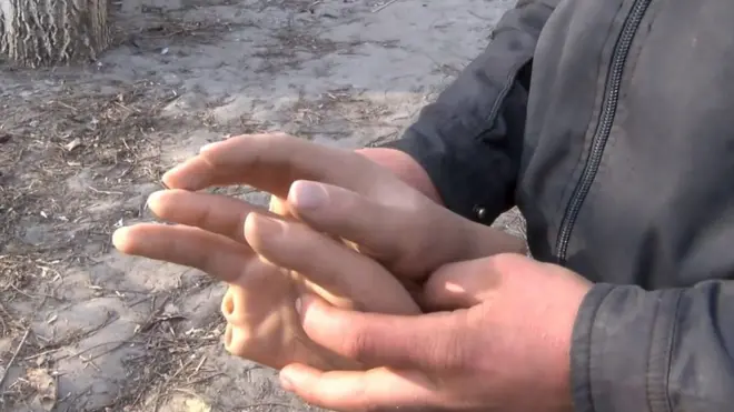 Ребенок, пострадвший от взрывчатки на Донбассе