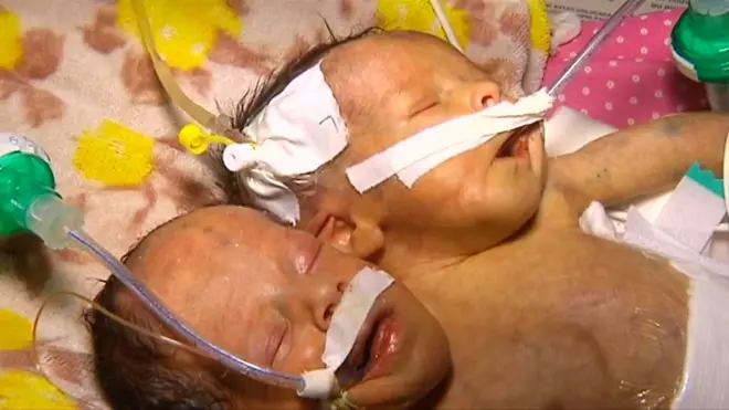 يحتاج توأمان ملتصقان ولدا في اليمن بصورة ماسة للعلاج في الخارج، لكن لا يتسنى لهما ذلك بسبب الحرب التي تسببت في إغلاق مطار العاصمة صنعاء.