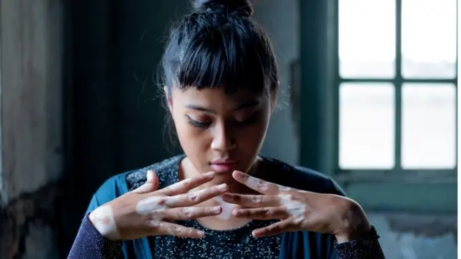 Malaysian photographer takes self portrait of her vitiligo