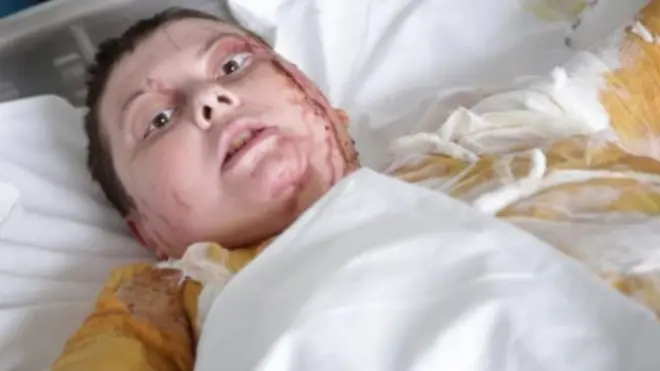 የዩክሬን ባለስልጣናት በአሲድ ጥቃት ክስ ተመሰረተባቸው