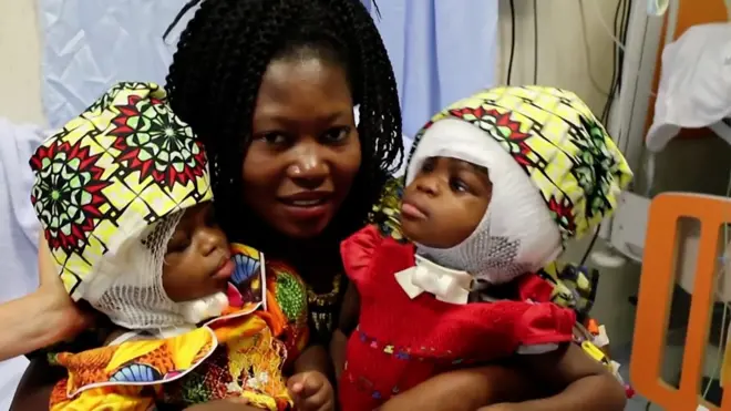 Devojčice su uspešno razdvojene