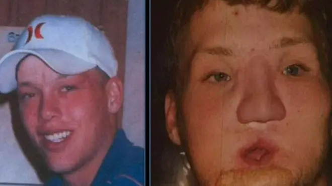 نجاح عملية زرع وجه كامل