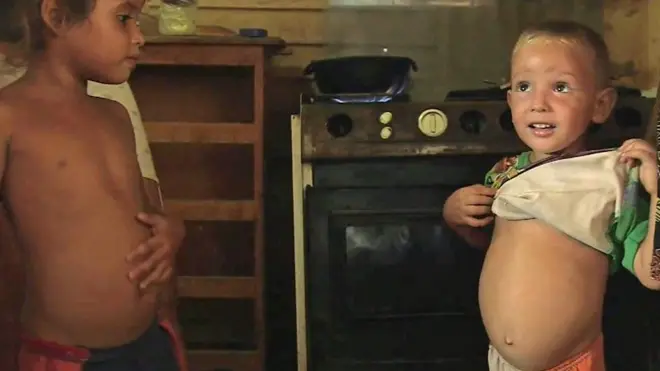 Niño con la barriga hinchada