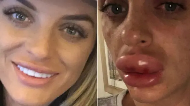 Rachael Knappier dice que gritaba de dolor.