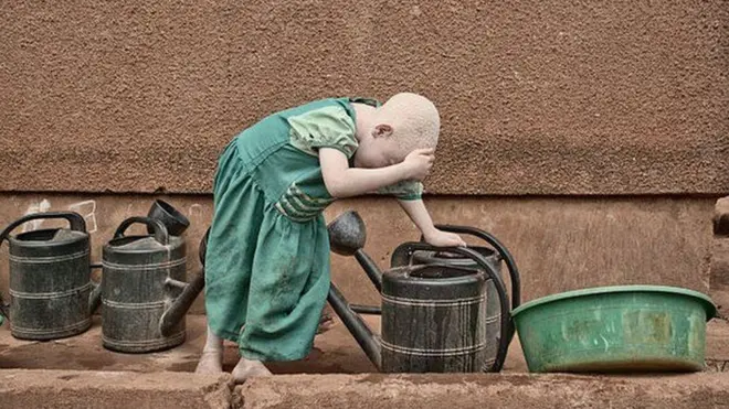 Dhibeen Albinism Taanzaniyaatti namoota 1,400 keessaa nama tokko irratti mul'ata.