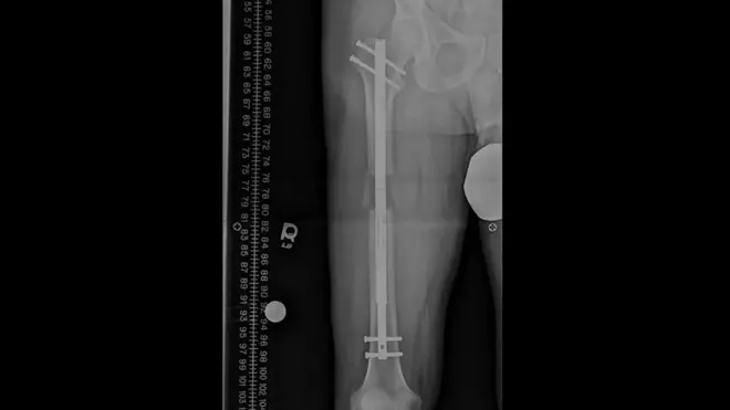 Rendgenski snimak noge