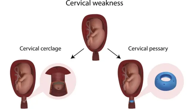 Akpankwa adịghị ike nwere ike ibute ime ọpụpụ
