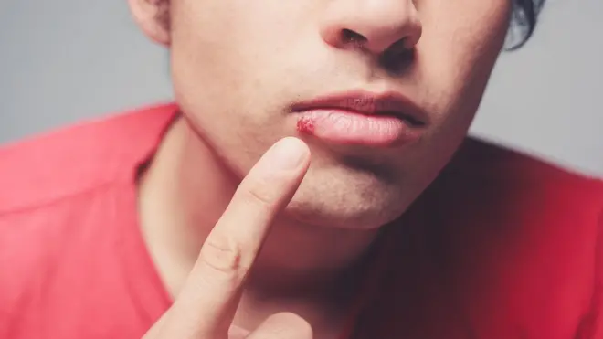 Infecta a la mayoría de las personas en la infancia y luego permanece latente en el sistema nervioso periférico.