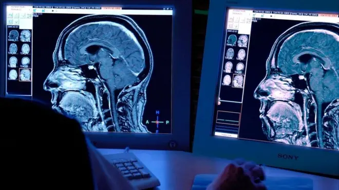 Desde hace tiempo se sabe que lesiones en el cerebro pueden afectar la personalidad.