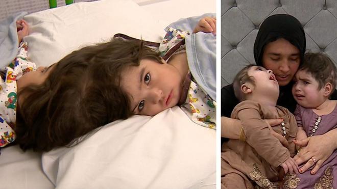 Сафа и Марва - сиамские близнецы, их разделили после сложнейшей трехэтапной операции.