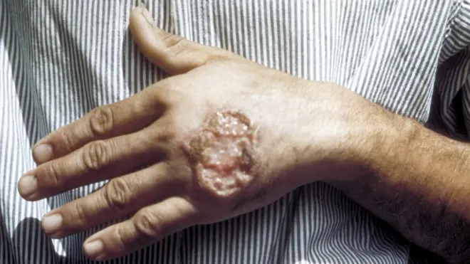 لیشمینیاسس