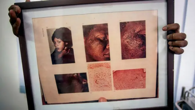 Hydroquinone fit destroy pesin skin