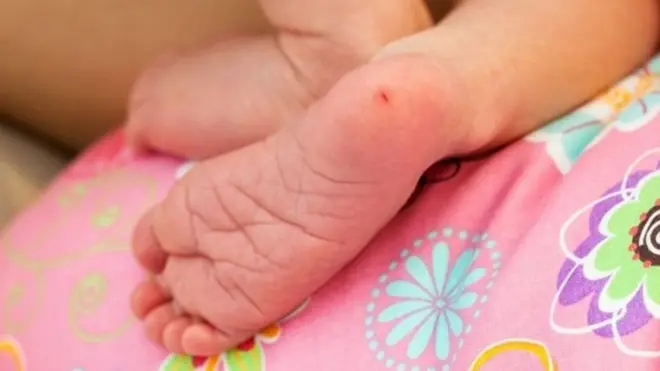 يجري الأطباء فحصوات للكشف عن فرط الكوليسترول بالدم من خلال أخذ عينة دم من كعب الطفل