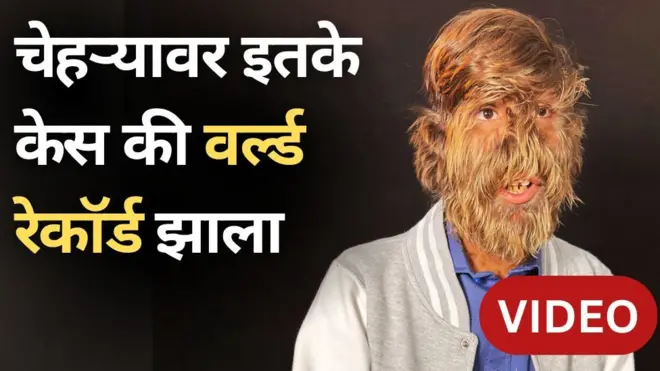 मध्यप्रदेशच्या ललितला चेहऱ्यावर इतके केस की वर्ल्ड रेकॉर्ड झाला