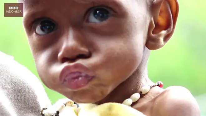 'Krisis gizi buruk di Asmat itu lingkaran setan'