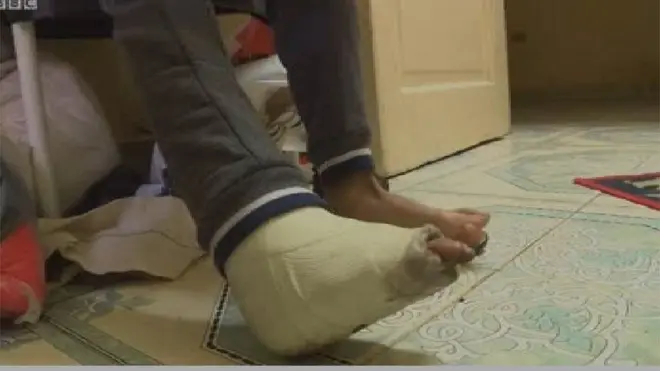 "هل لا تزال ساقي موجودة"