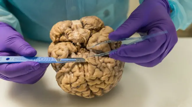 Ya no hay que esperar a morir para donar el cerebro a la ciencia.