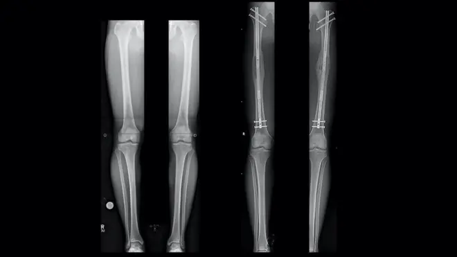 ቀዶ ሕክምናውን የሚያደርጉ ሰዎች ቁጥር ከጊዜ ወደ ጊዜ እየጨመረ መጥቷል።
