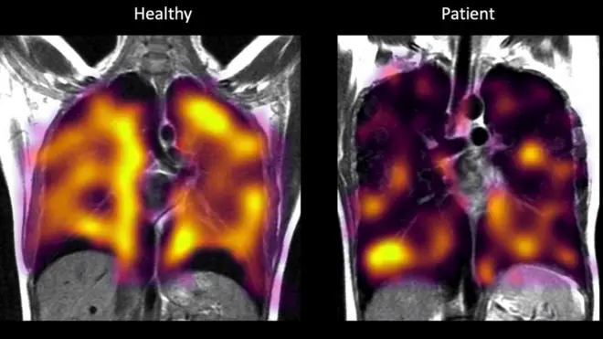 Lung scans showed larger areas of darkness in patients with long Covid than healthy controls - signalling potential abnormalities