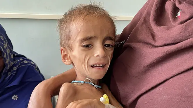 A malnourished child in Kandahar in October