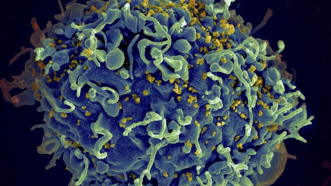 Micrografia eletrônica mostra HIV infectando célula humana