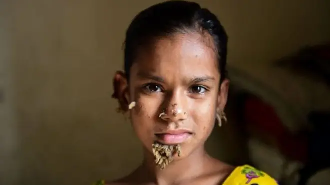 රෝග විනිශ්චය නිවැරදි වුවහොත් "ට්‍රී මෑන් සින්ඩ්‍රොම්" සහිතව දැනට ලෝකයේ ජීවත්වන කිහිප දෙනා අතරට සාහානා ද එක්වනු ඇත