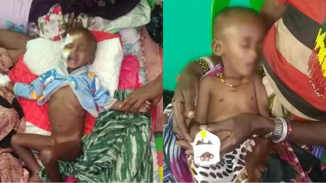Daa'imman hanqina nyaataan miidhamanii Hospitaala Meeggaatti yaalamaa jiran