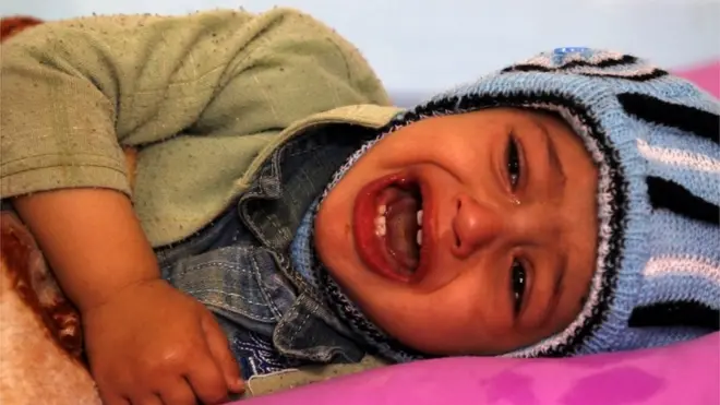 طفلة مصابة بالكوليرا تعالج من المرض صنعاء