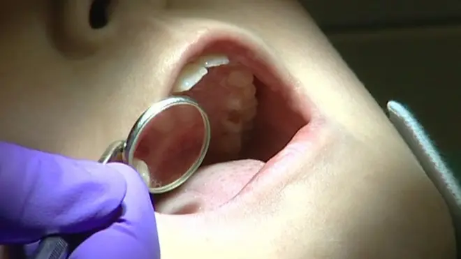 أمراض اللثة "تزيد خطر الإصابة بالسرطان لدى النساء"