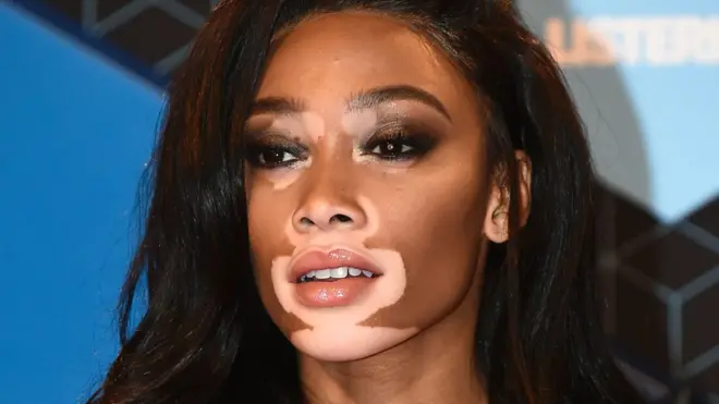 Winnie Harlow