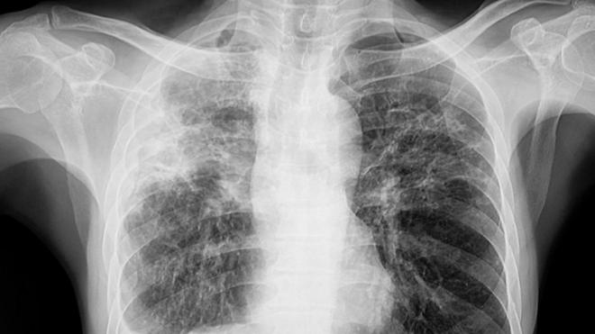 Raio-x de pulmão de paciente com tuberculose