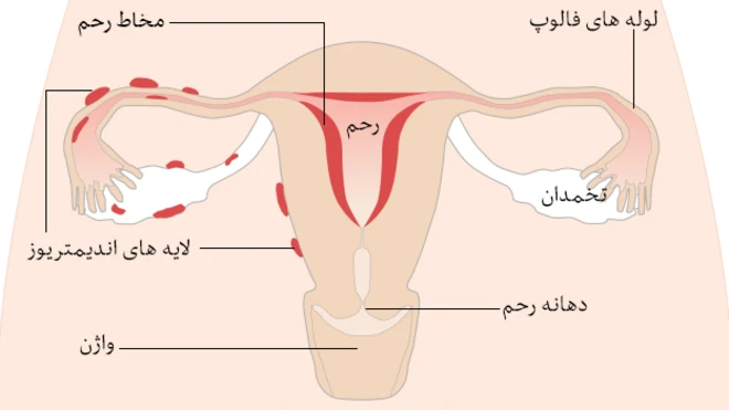 اندومتریوز