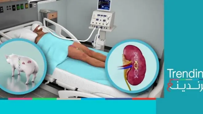 لأول مرة.. نجاح زراعة كلية خنزير في جسم إنسان