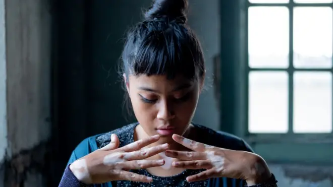 Malaysian photographer takes self portrait of her vitiligo