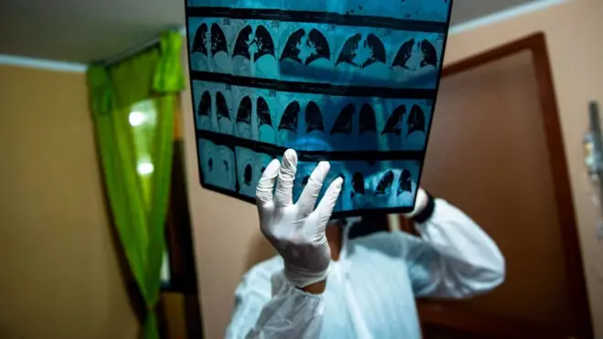 El estudio de personas que muestran niveles inusuales de resistencia o susceptibilidad al covid-19 puede conducir a nuevos tratamientos.