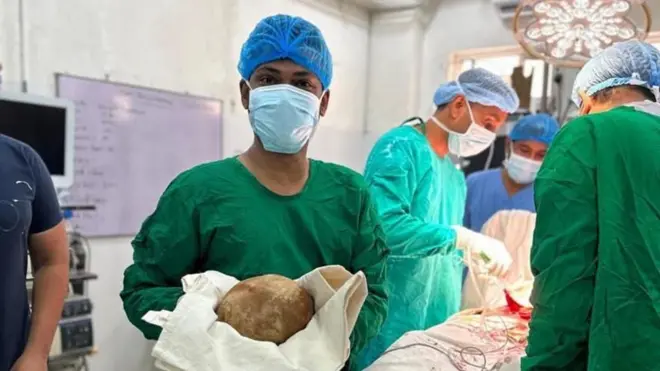 श्रीलंकेत डॉक्टरांनी एका व्यक्तीच्या मूत्राशयातून हा खडा काढला आहे.